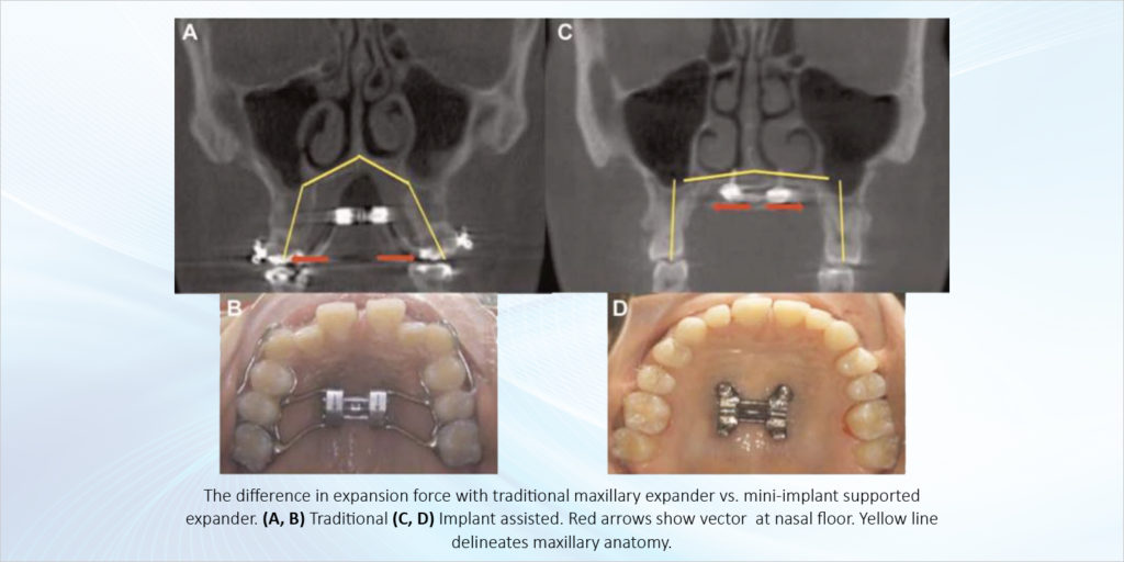 Dome Treatment for Adult Obstructive Sleep Apnea Patients with High